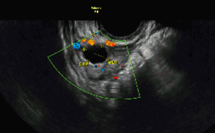 Varicocele Treatment in Noida - Anaya IVF & Fertility Care